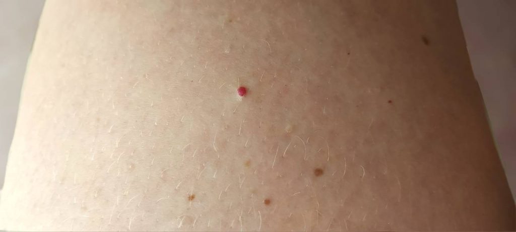 cervene znamienka na kozi