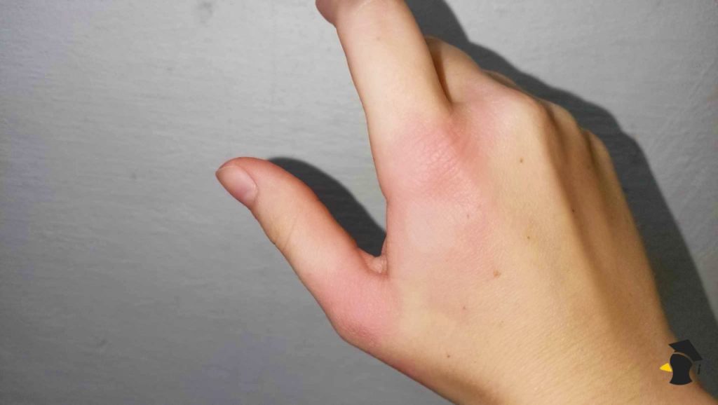 Komár, osa, kliešť či blcha? Nauč sa rozoznať a správne ošetriť letné štípance!