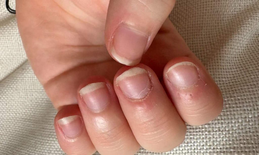 Tvoje nechty prezrádzajú viac, než si myslíš. Tieto zmeny môžu signalizovať problém v tele